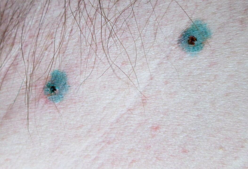 Marcas na pel despois da eliminación con láser de papilomas