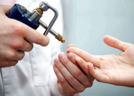 Eliminar unha verruga nun dedo usando nitróxeno líquido
